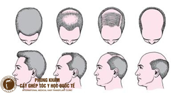 Cách chữa hói đầu di truyền ở nam giới