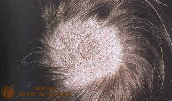 nấm da đầu gây rụng tóc