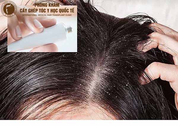 nấm da đầu gây rụng tóc