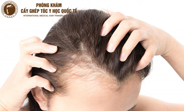 Phương pháp chữa rụng tóc hình chữ M hiệu quả nhất hiện nay