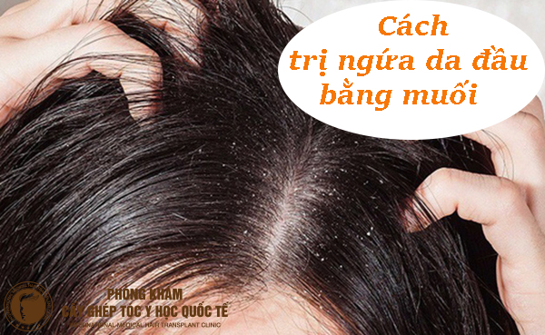 Cách trị ngứa da đầu bằng muối