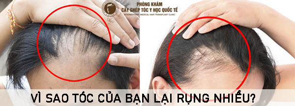 vì sao tóc của bạn lại bị rụng nhiều