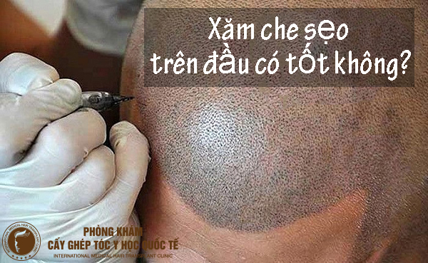 xăm che sẹo trên đầu có tốt không