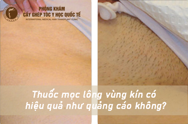 thuốc mọc lông vùng kín