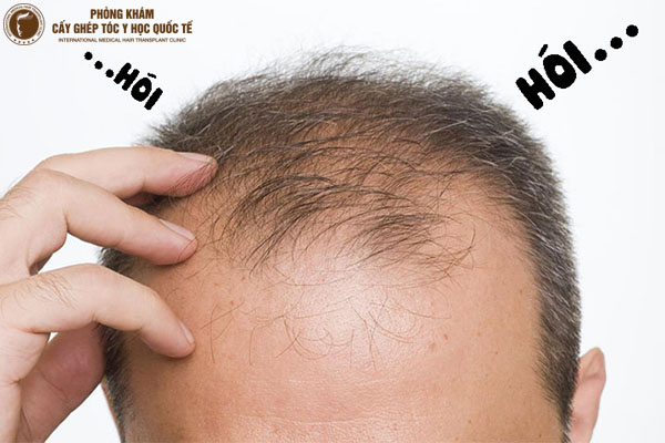 cách chữa hói đầu ở nam giới