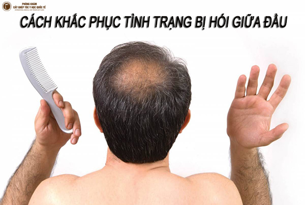 bi hói giữa đầu