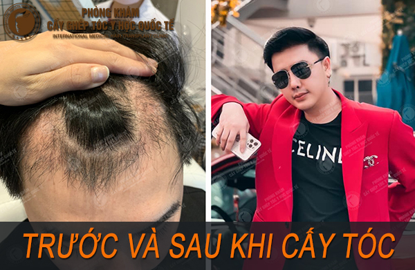 rụng tóc không sẹo là gì