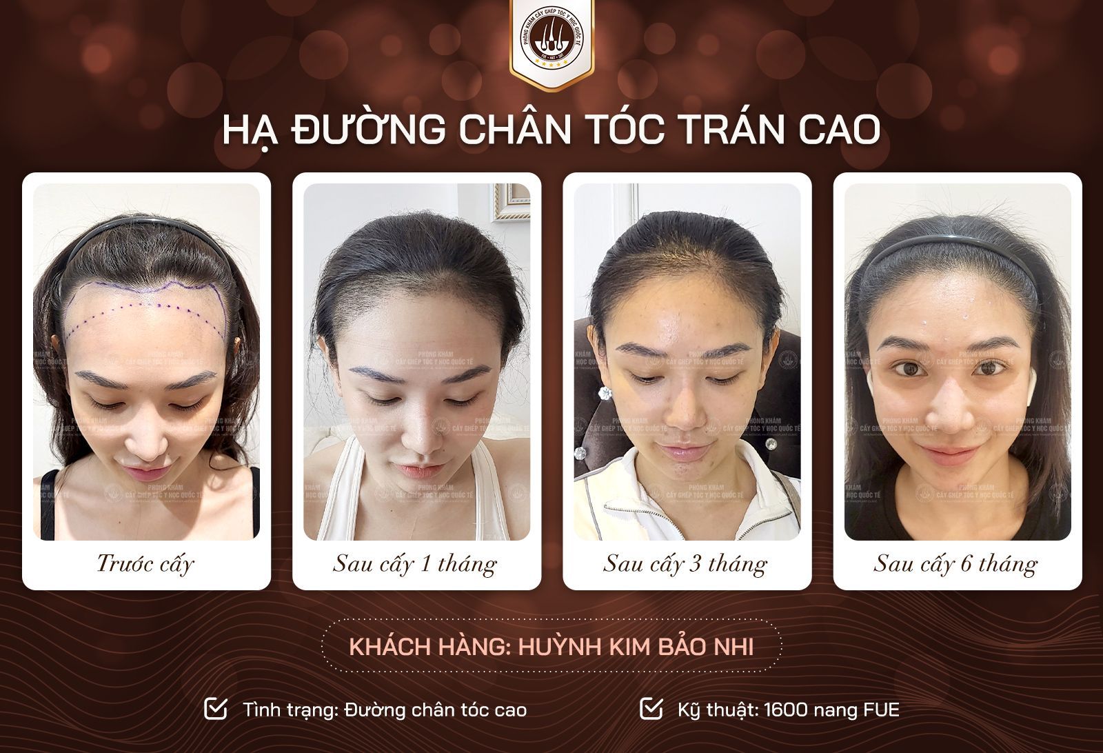 cấy đường chân tóc ở nữ 