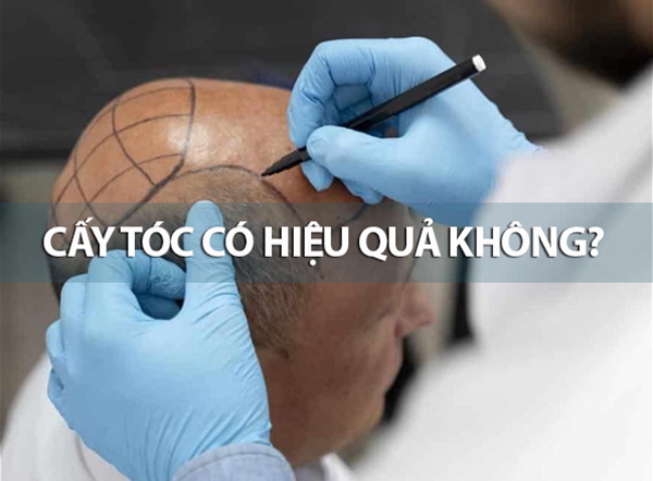 cấy tóc tự thân có hiệu quả không, cấy tóc có hiệu quả không, phương pháp cấy tóc có hiệu quả không, cấy tóc có hiệu quả lâu dài không, cấy tóc có hiệu quả, cấy tóc hiệu quả không, cấy tóc có thật sự hiệu quả,