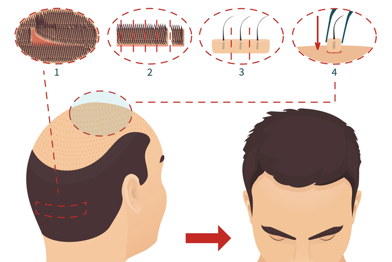 bản chất của cấy tóc 