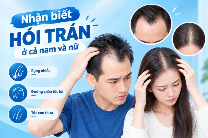 cách nhận biết hói chữ M ở Nam và Nữ 