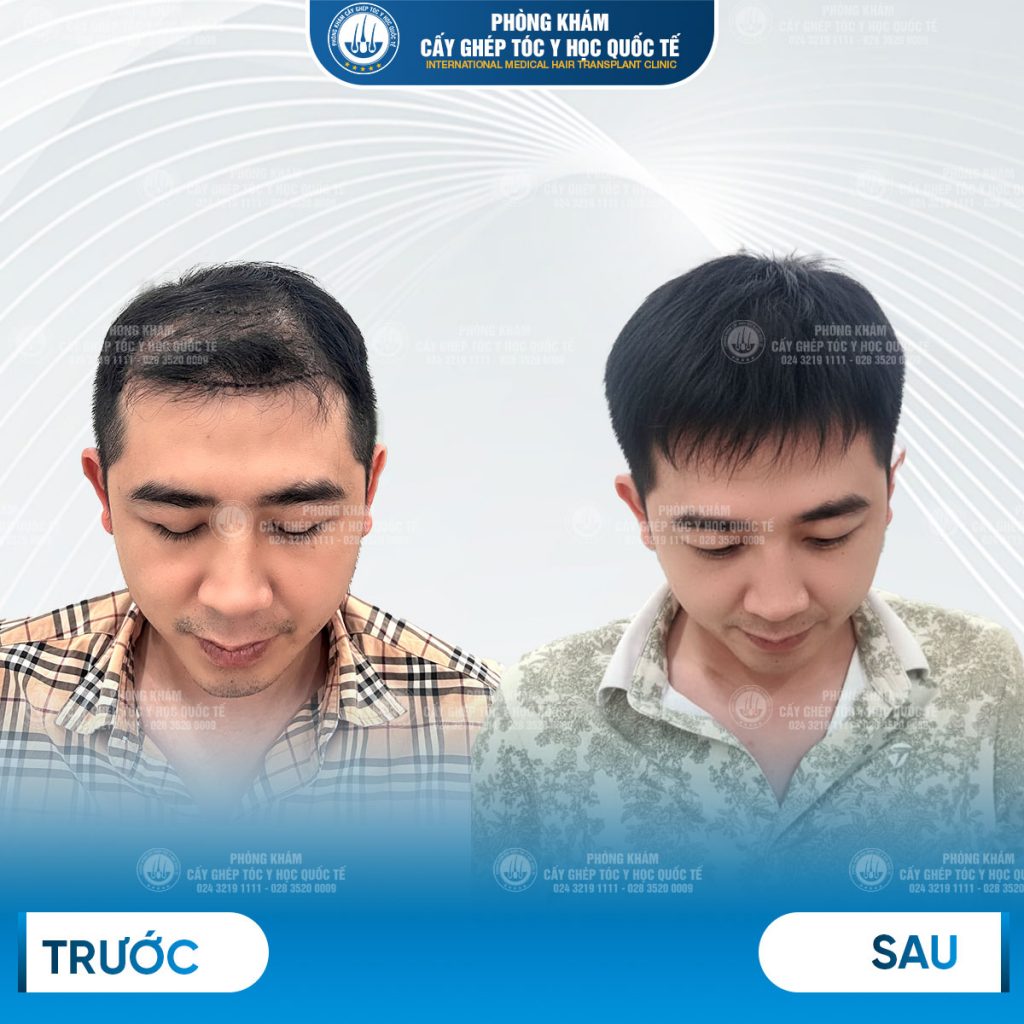 kết quả sau cấy tóc tự thân 