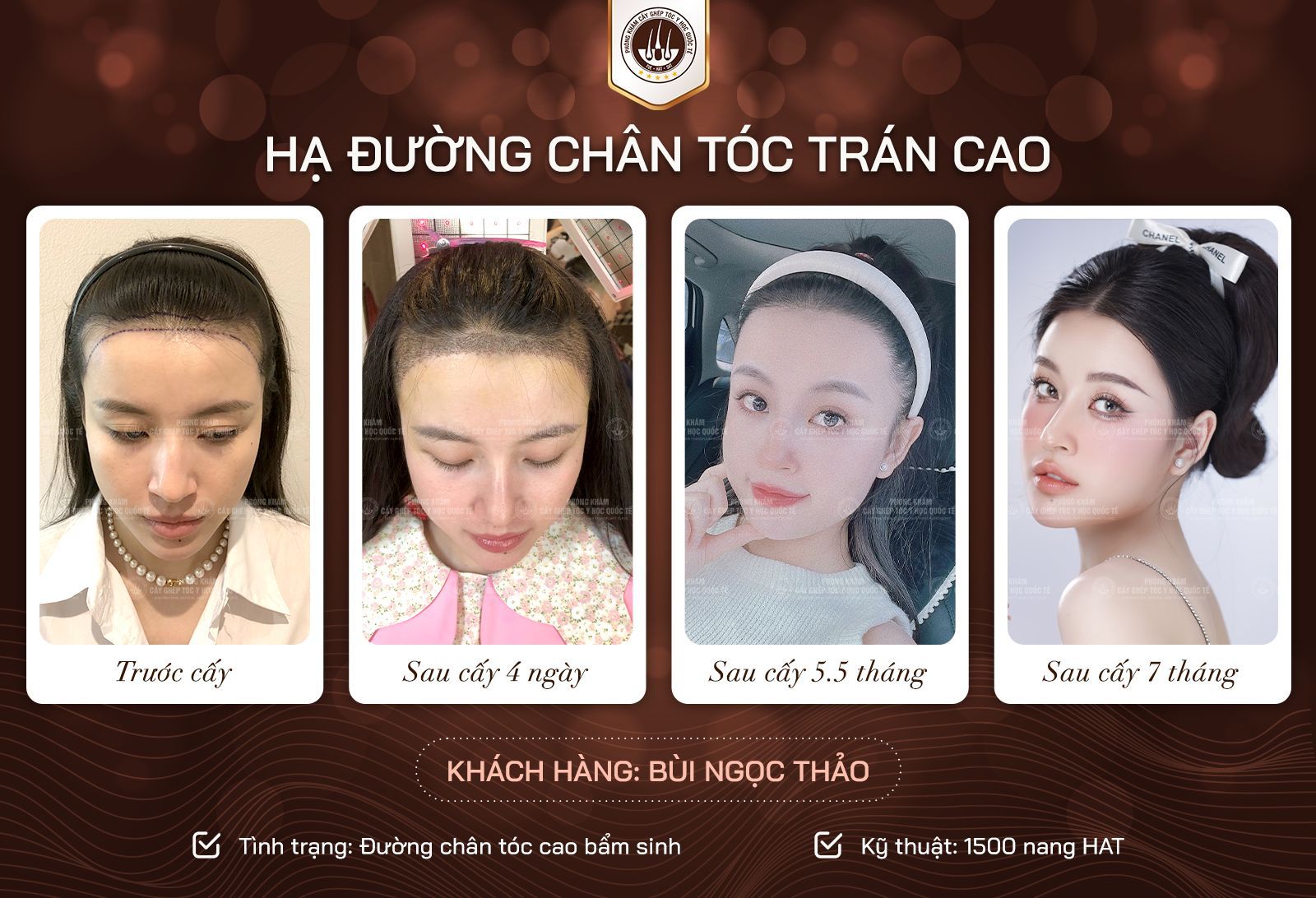 kết quả sau cấy tóc 