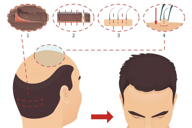 cấy tóc tự thân là gì 