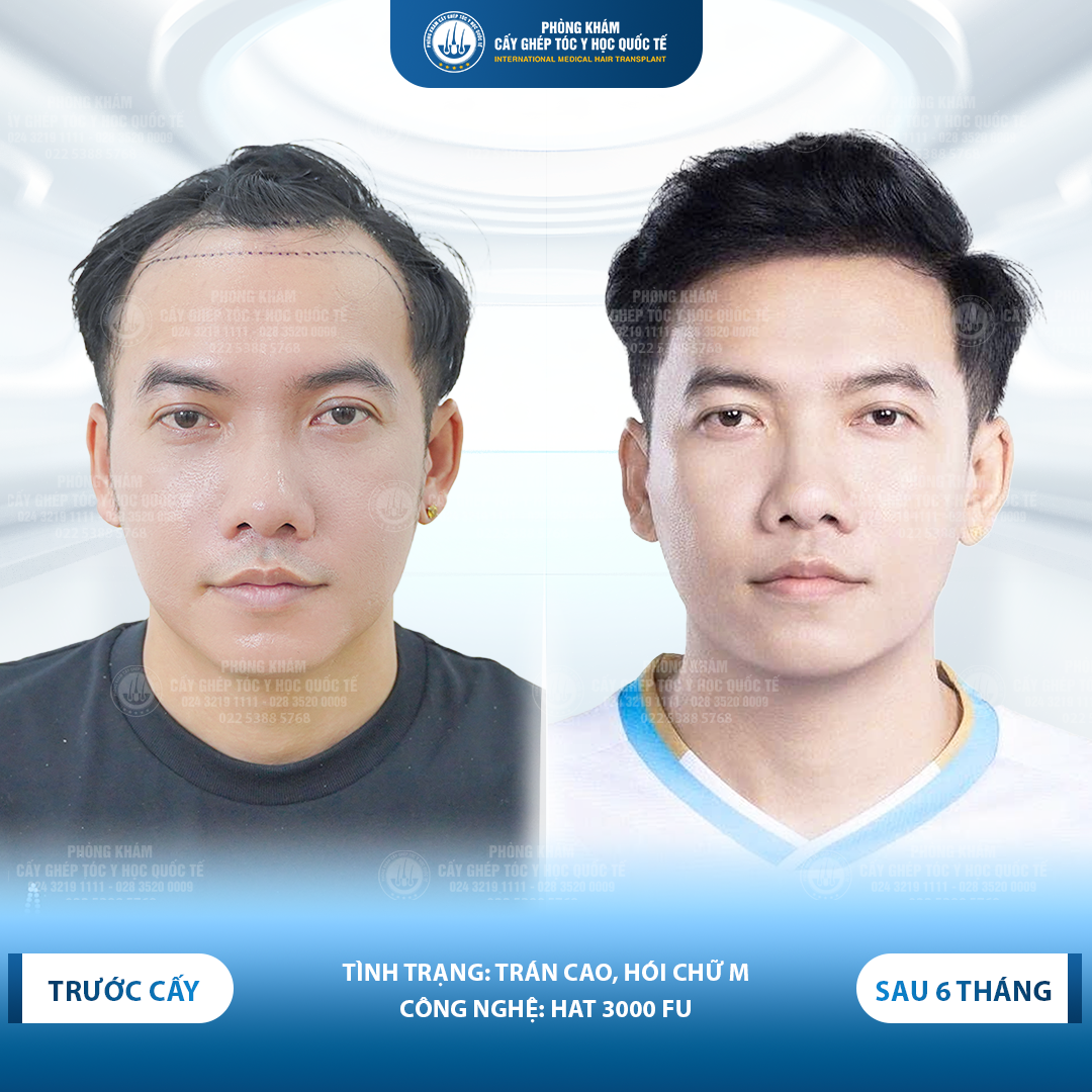 hiệu quả sau cấy tóc tự thân 