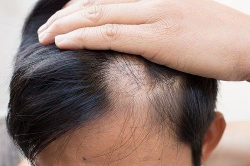 Có nên đi cấy tóc không