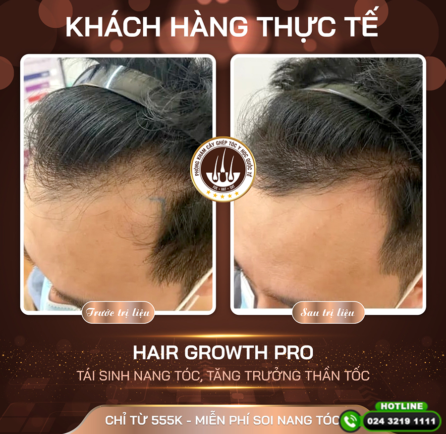 điểu trị rụng tóc 