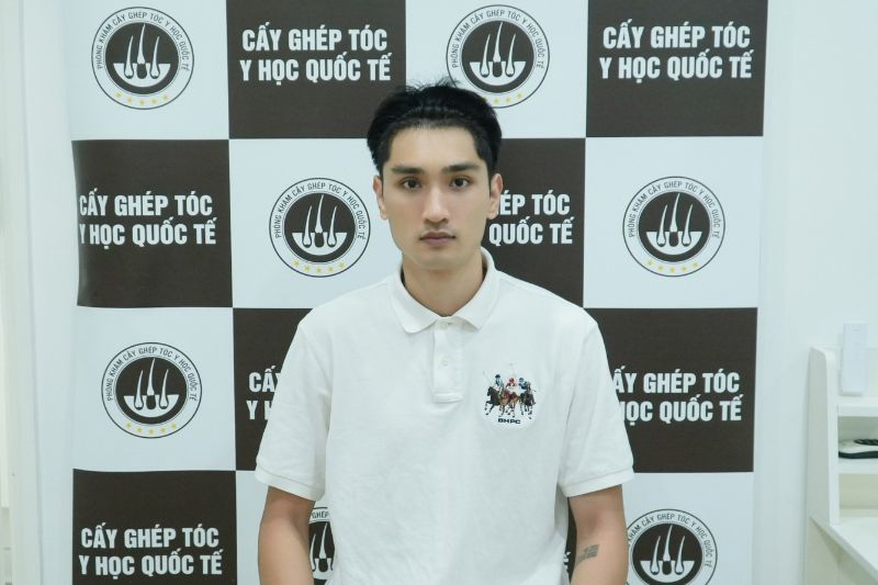 giai đoạn 10 ngày sau cấy tóc 