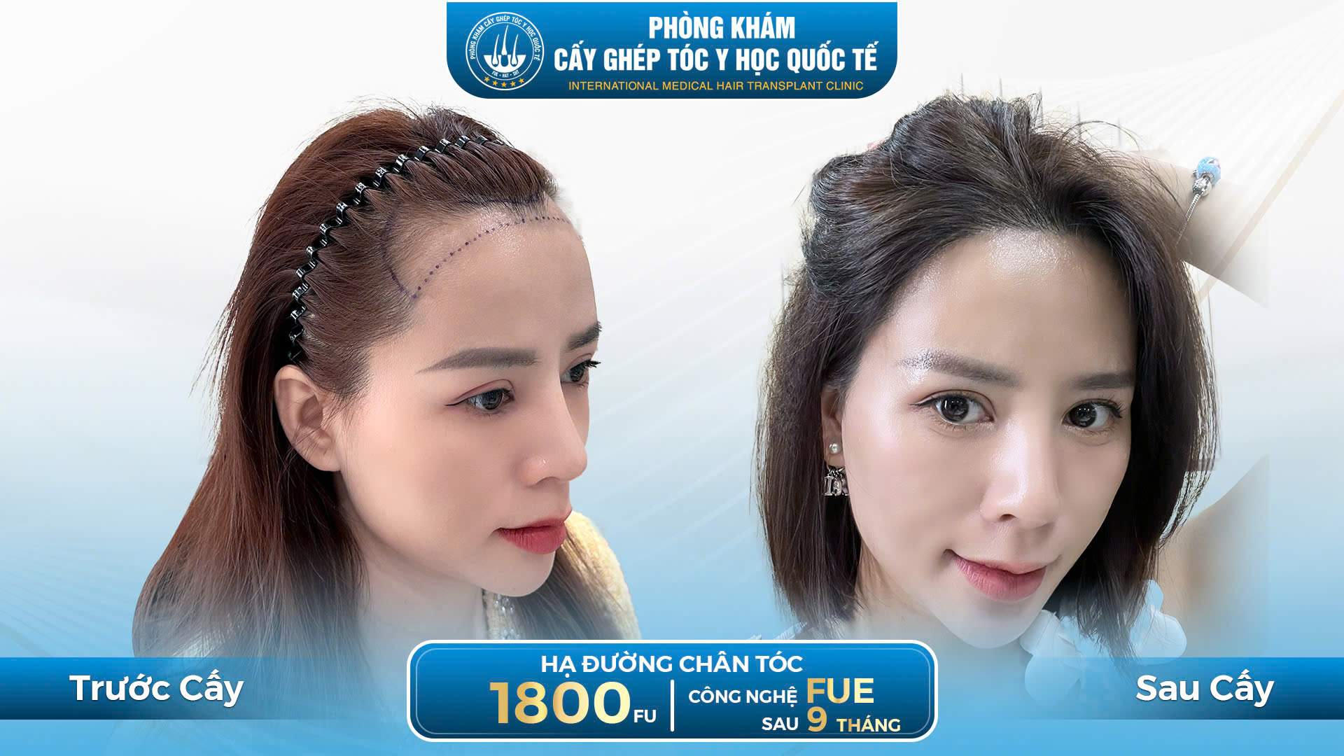 hiệu quả của cấy tóc tự thân 