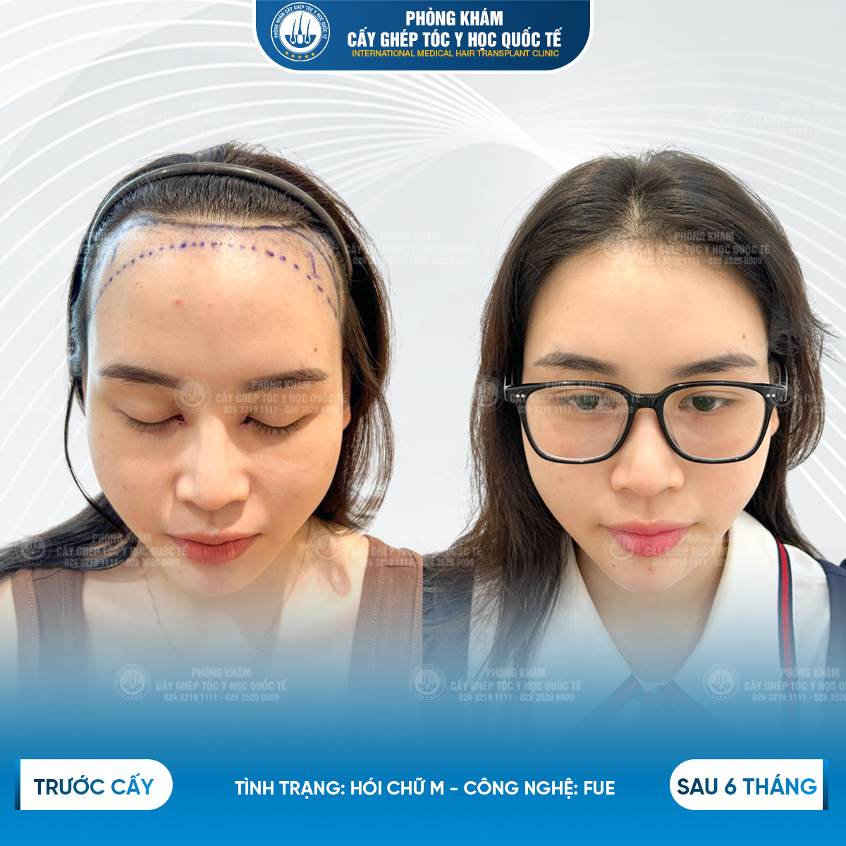 hiểu quả quá trình cấy tóc tự thân 
