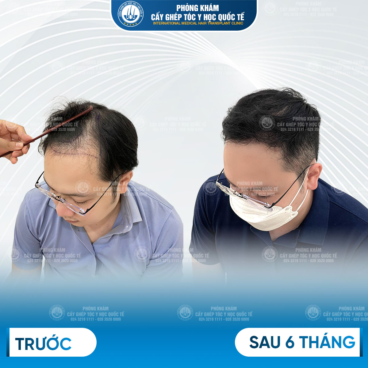 hiệu quả sau cấy tóc 