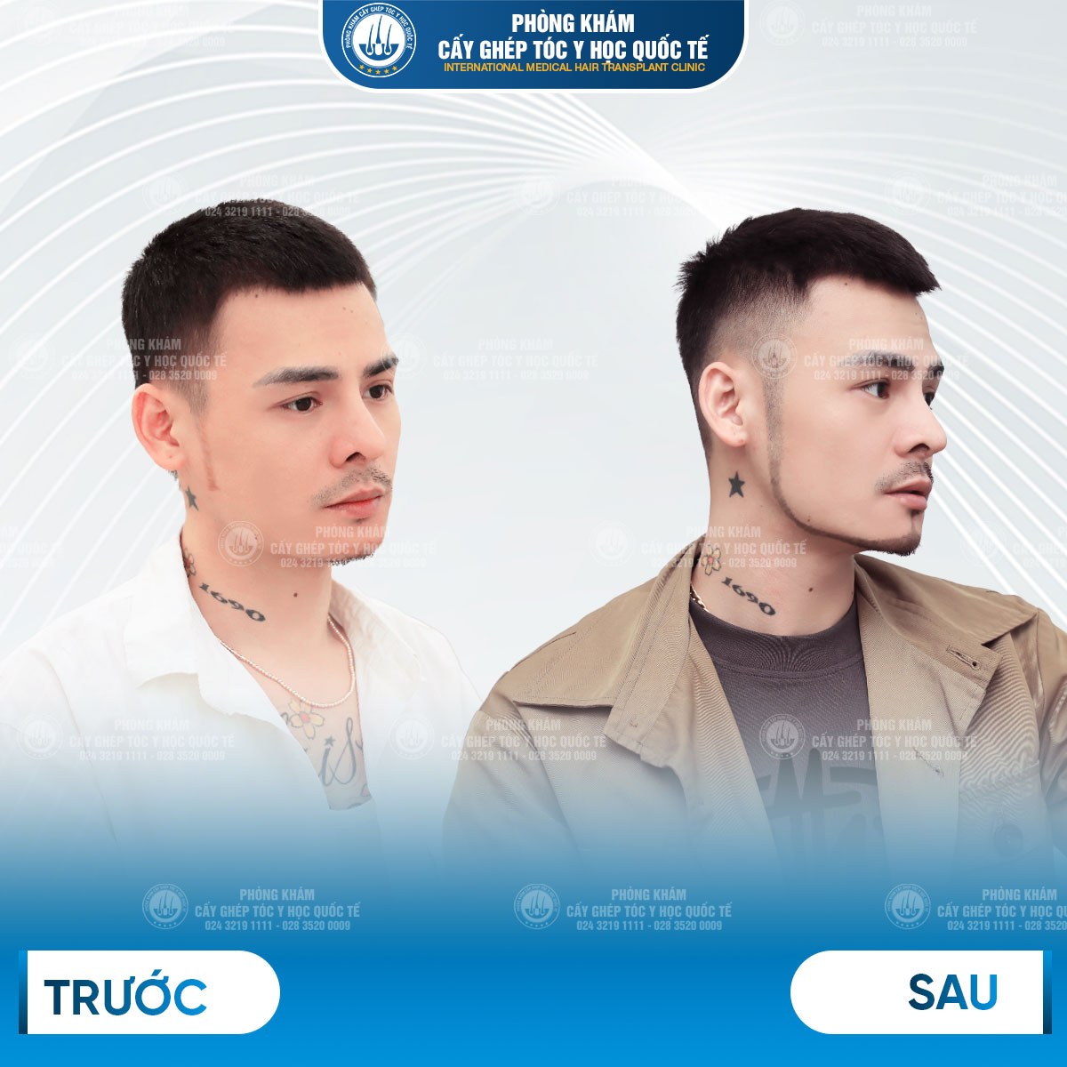 kết quả hoa vinh sau cấy râu tự thân 