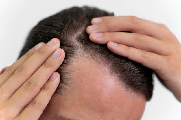 hói trán có chữa được không 