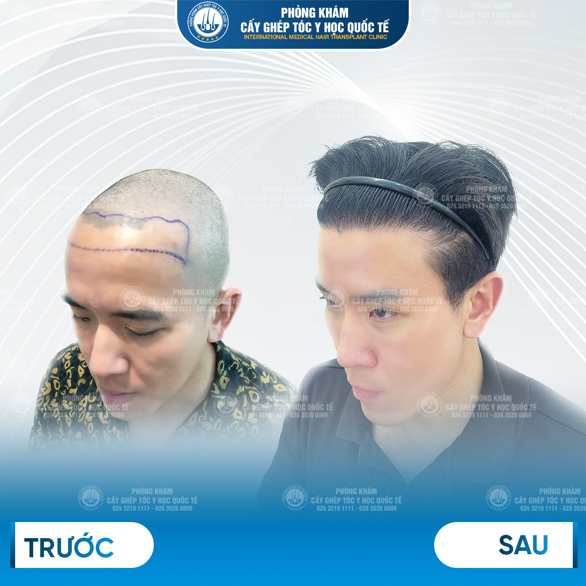 kết quả cấy tóc