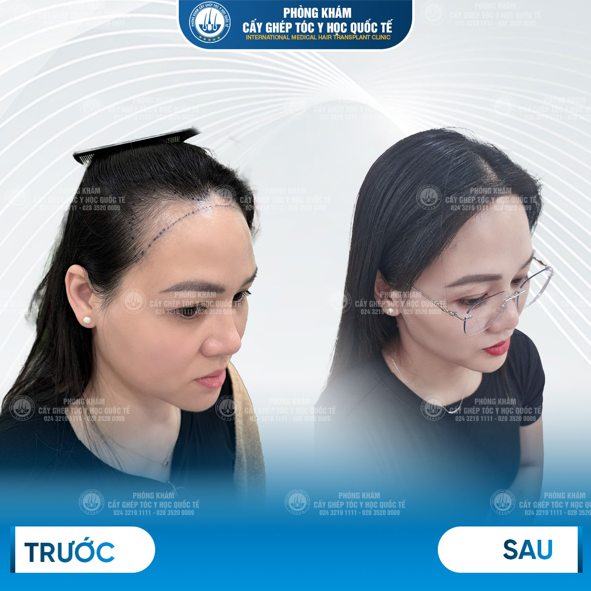 kết quả cấy tóc y học quốc tế 