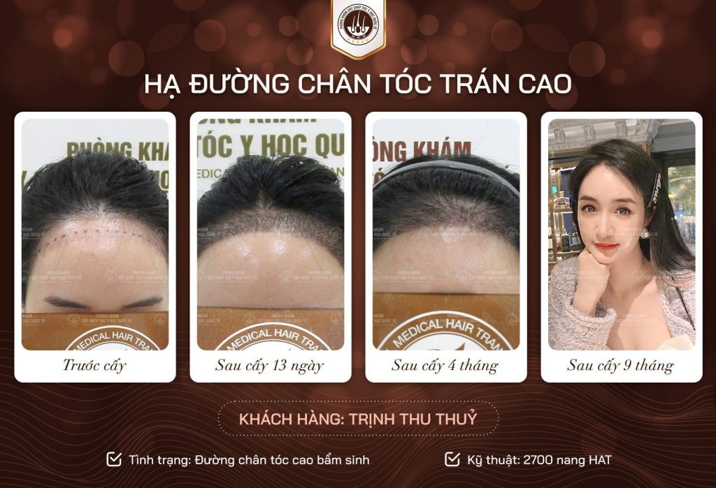 kết quả sau cấy 