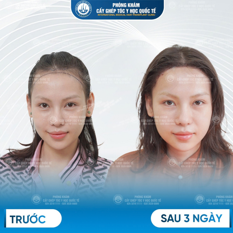 kết quả sau cấy sợi dài