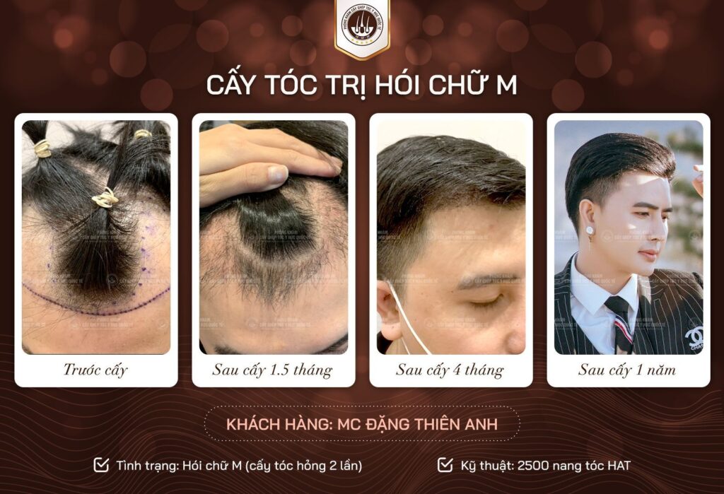 Cấy tóc tự thân 
