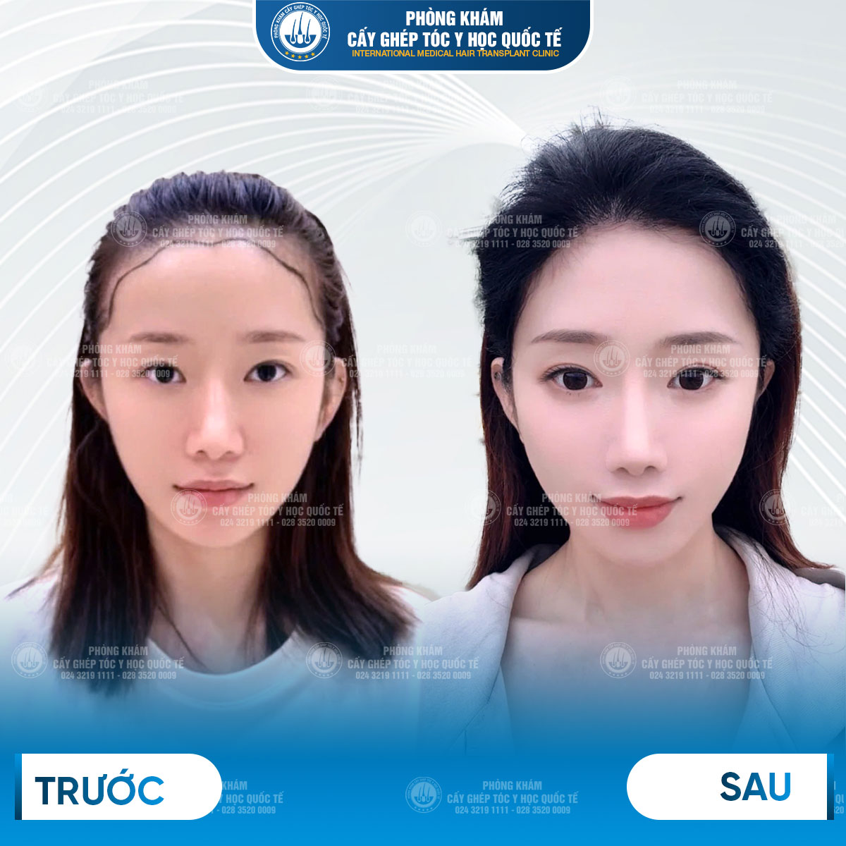 cách chữa hói đầu nữ giới 