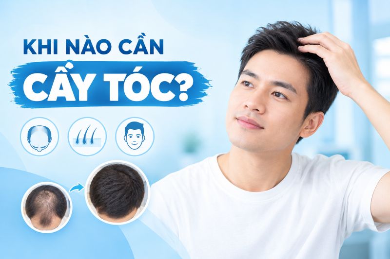 khi nào cần cấy tóc 