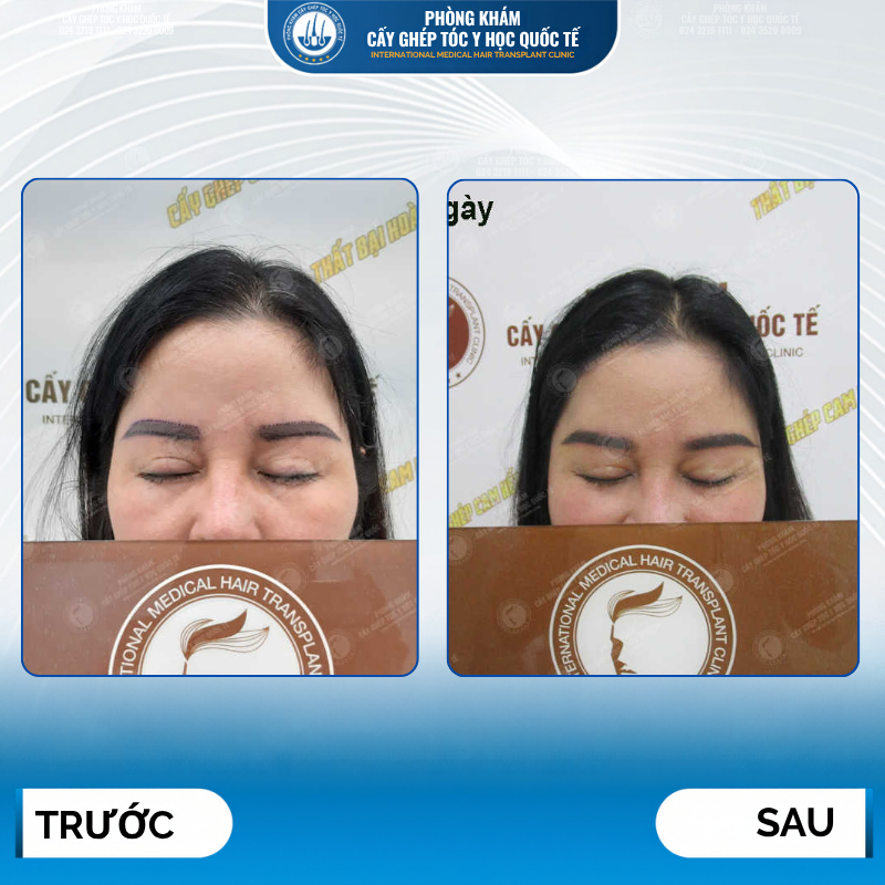 kết quả cấy lông mày