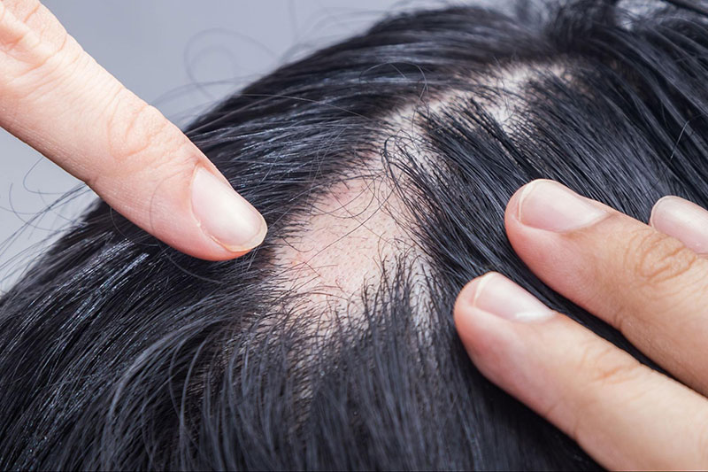 cách nhận biết tóc thưa trên đỉnh đầu 