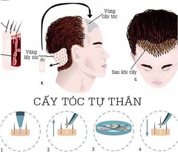 quy trình cấy tóc tự thân