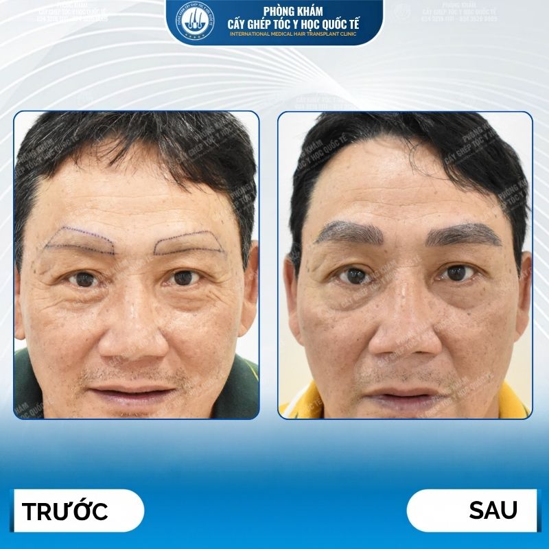 ưu điểm cấy lông mày 